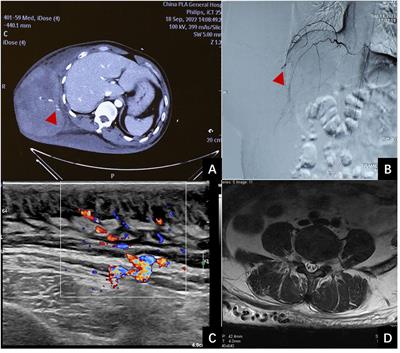 A life-threatening, massive subcutaneous hematoma caused by trauma in a patient with neurofibromatosis type 1: a case report and literature review